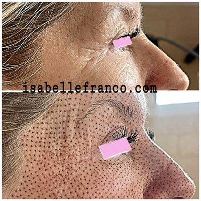 Fibroblast eyelid treatment non-surgical procedure, which tightens and lifts the skin around upper and lower eyelids with instant results.