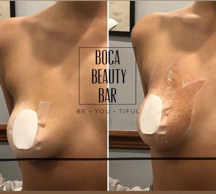 Breast lift