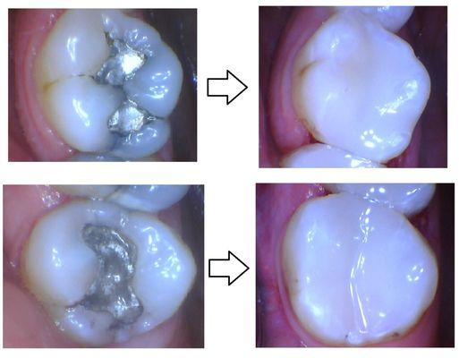 When old restorations breakdown and cause your teeth to fracture, we can restore them using tooth-colored restorations.