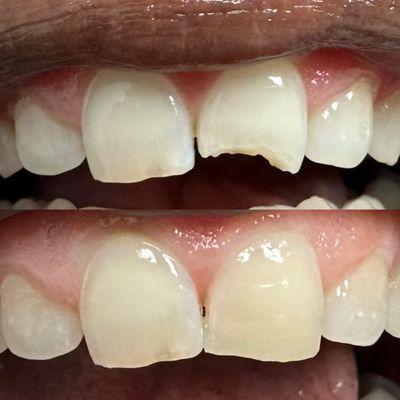 Chipped tooth filling