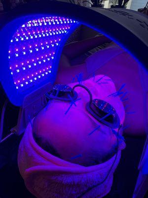 Cosmetic Acupuncture for Anti-Aging and Wrinkle Reduction and LED Red/Blue Light Therapy