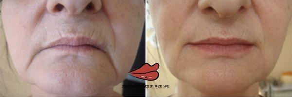 2 syringes of Juvederm ultra plus used for Nasolabial folds and Marionette lines.