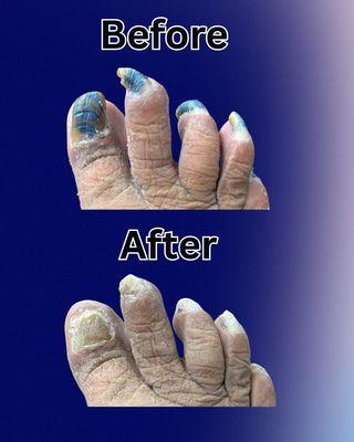 Before and After Podiatric Care: Thick or painful nails? We clean and trim them safely the same day you come in.
