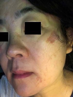 Taken two days after waxing at Threading by Asiya -- visible burns and no accountability from the business. Be cautious.