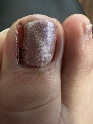 I did not have an ingrown toenail. They cut my nails too short and cause me to have an infection! Their error sent me to urgen care! WARNING