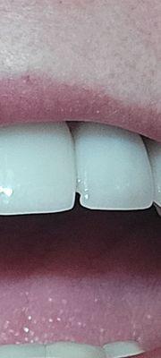 Chipped crown- 12 days after put on