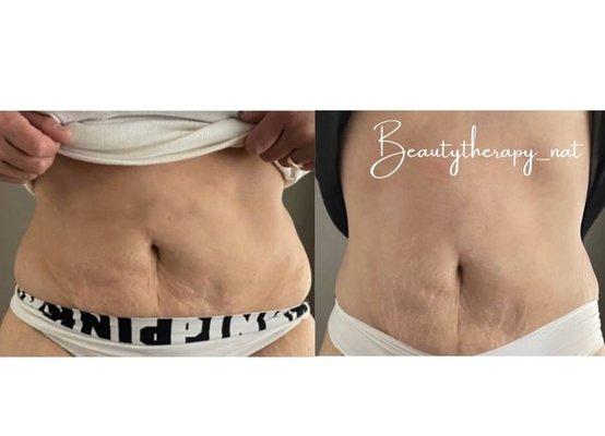 Cavitation treatment and laser Lipo