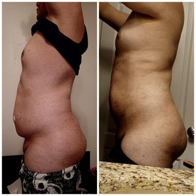 (1st photo) 13 days before (2nd photo) 13 days after surgery "round 2"