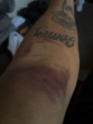 They were pumping my red blood cells to quick and bruised my arm been going here 4 times already and its the only accident I've gotten here.