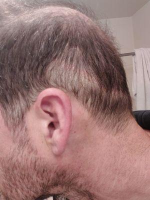 Bald spot just under scar not even touched. Literally the focus of this procedure.