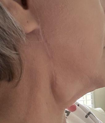 After surgery and two revisions.