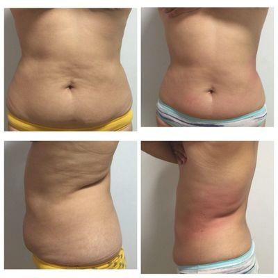 Before and after our body sculpting treatment.