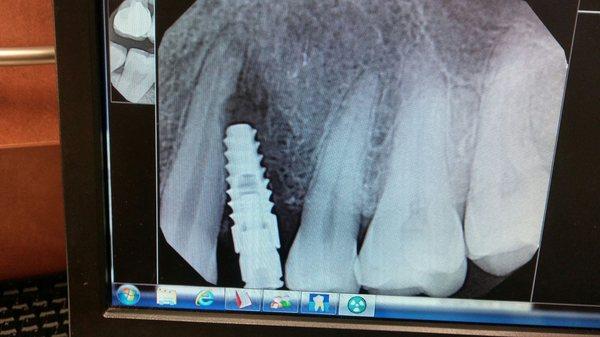 Crooked and failing implant, dentist actually damaged the tooth beside it when he drilled