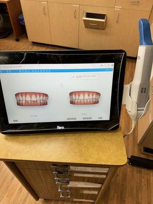 After your tooth scan, we will show you a simulation of your before and anticipated after results!
