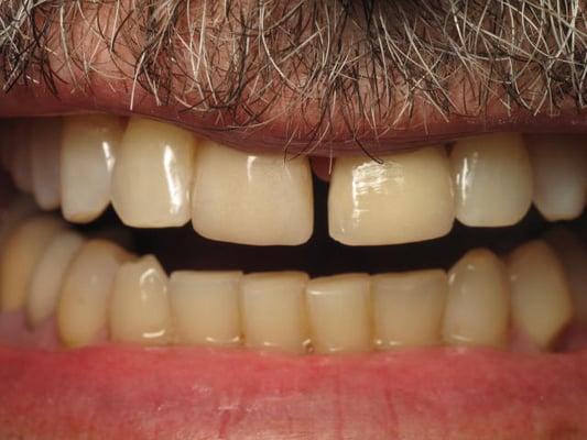 Before closing Gap With Bonding