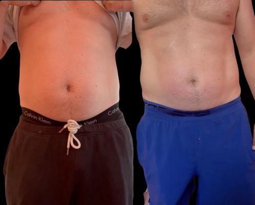 AI-powered body sculpting: melt 2-3 inches off your stomach in 4 hours. Smart, fast, non-invasive.