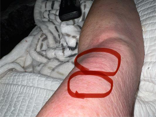 Allergic itchy rash and welts.