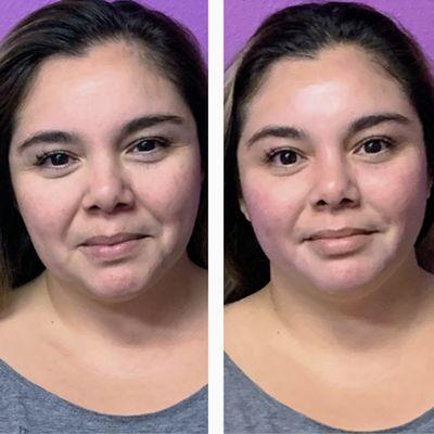This beauty had great results after just one Custom Facial. She said she could see her face was radiant & less puffy. Call now for your appt