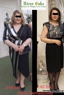 HCG and Semaglutide weight loss