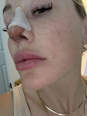 Post op (easiest recovery I've ever had and this is my fourth revision).