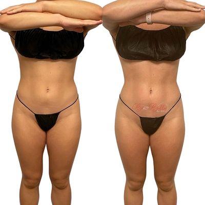 One session of abdomen and waist toning + skin tightening.