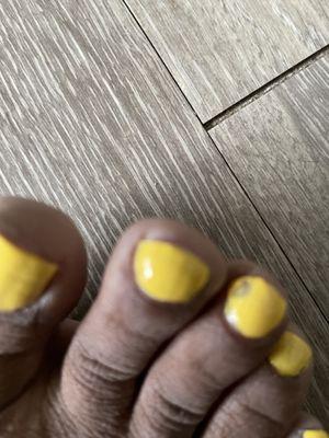 Toe next to middle toe is messed up. A toe separator would have prevented this.