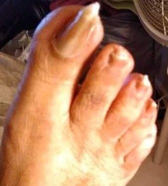 This is how Podiatrists Lee Womick left my toes after clipping my toe nails.