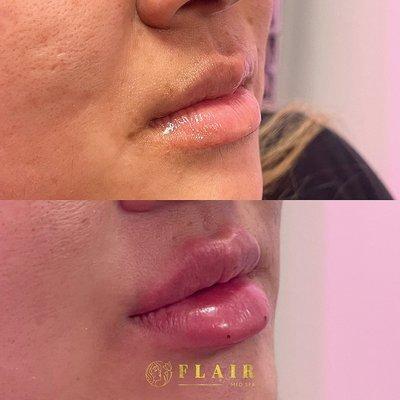 Half syringe of Juvederm Ultra Plus in the lips.