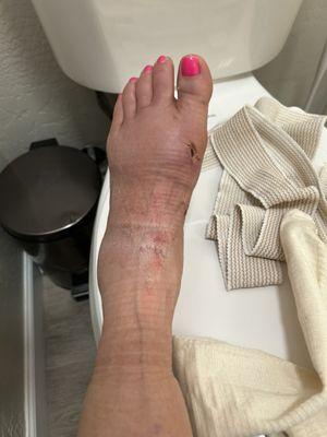 My foot is so swollen- no way my shoes will comfortably fit.