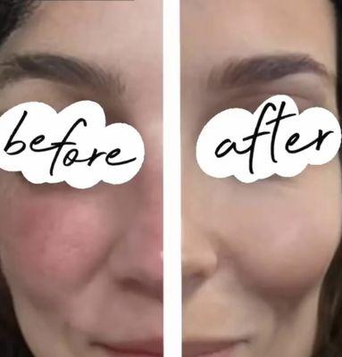 Laser Therapy for Rosacea