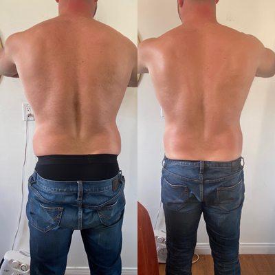 Same day results with a deluxe session of Lipo Cavitation.