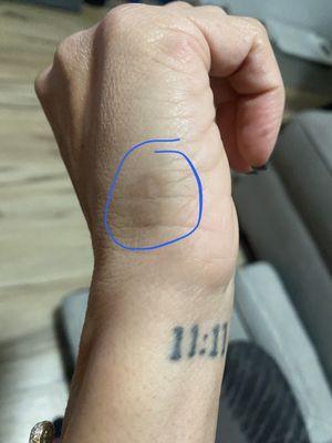 Side of my had indicating the scar and dark spot.