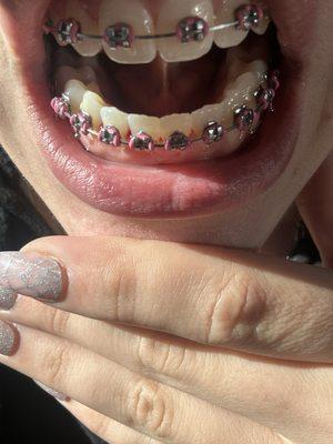 This is after rinsing my mouth multiple times