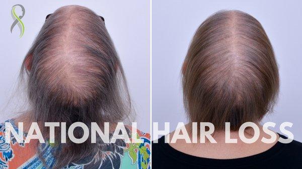 Female Hair Loss - Before & 10 Month Results