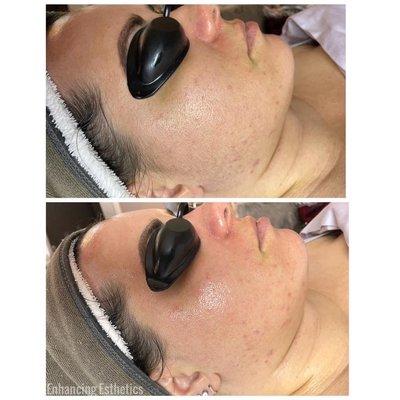 Anti-aging facial with a dermaplane add on. Top before, bottom after pic.