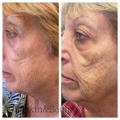Anti-aging fibroblast treatment