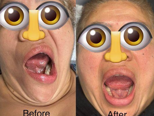 #OC_acupuncutre #Bell's_palsy #stress_relief #anxiety #herbs #cupping