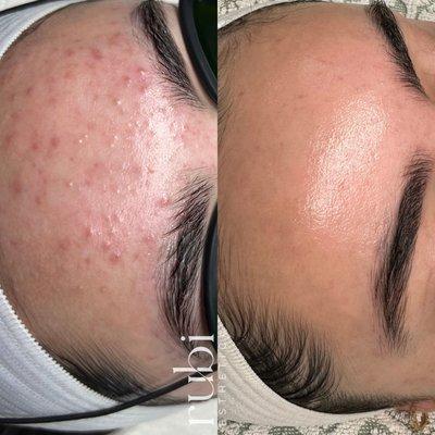 Acne client before and after!