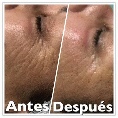 Come make an appointment to see jessenia. You won't be disappointed. My mother and I got our microdermabracion .