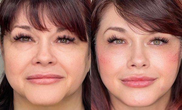 Fillers for her lips, cheeks and chin to create a more youthful appearance. Plasma pen under her eyes to help with under eye bags.