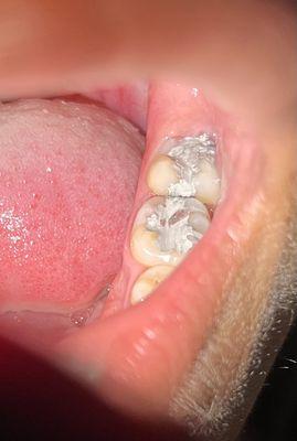 De los rellenos que me le hicieron a mi hijo aparte ni es blanco lo que le pusieron