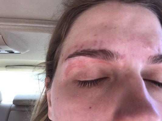 Burned from the eyebrow wax