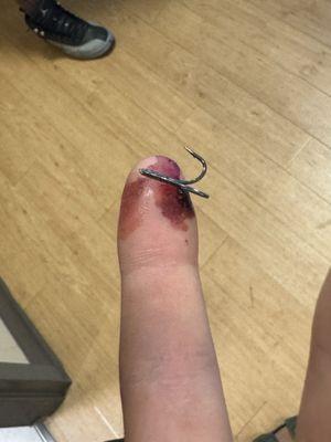 This took the ER less than 10 minutes to remove. We arrived 45 minutes before closing.