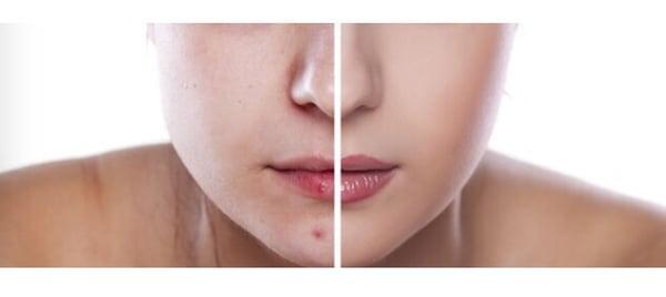 Jessner chemical peels at GK dermatology