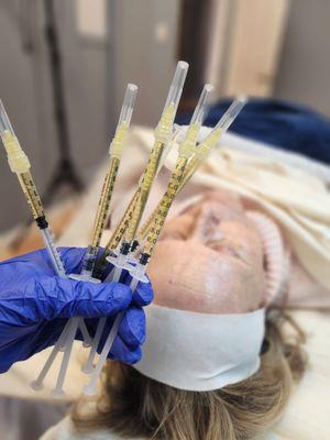 PRP uses your own plasma to regenerate your skin by producing collagen and increasing cell turnover. Get a youthful glow & reduce wrikles