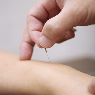 Acupuncture Health