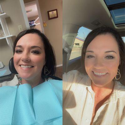 I got a flipper tooth from Dr. Cross today.