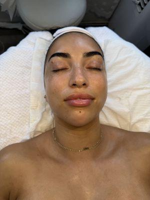 Beautiful results after a dermaplaning, Hyauronic layering. Red and blue LED and vitamin C