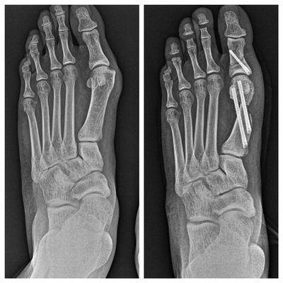 Minimally invasive bunion correction