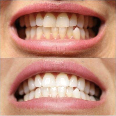 Tooth Whitening